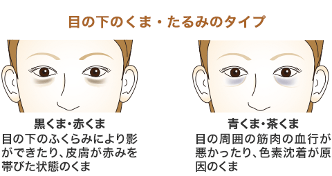 皮膚を切らずに目の内側の粘膜から脂肪を取るため、傷跡の心配がほとんどない。