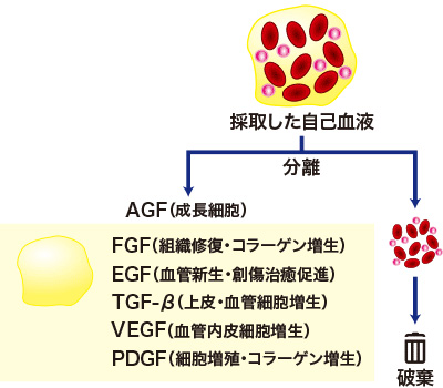 成長細胞（AGF）注入